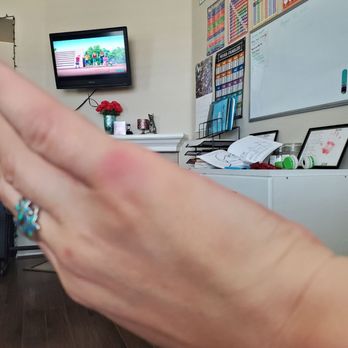 Temecula Wine & Beer Garden - Bruise on hand from them grabbing and dragging her - Bars Near Me - Temecula, California Temecula Wine & Beer Garden - Bruise on hand from them grabbing and dragging her - Bars Near Me - Temecula, California