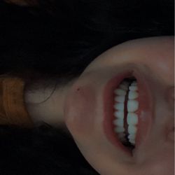 SmileLife Orthodontics - My smile after is exactly how I imagined!