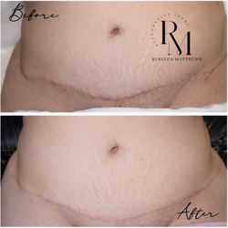 Restorative Ink by Rebecca Matthews - Scar Revision