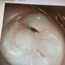 Keith C Henderson, DDS APDC - Before the crown...it was a old filling with fractures and decay.