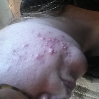 Claude Michel Salon - This is my result after getting 3 or 4 facials from this lady!! - Hair Salons Near Me - Alexandria, Virginia