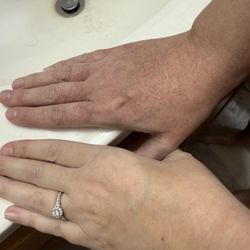 Ascension NE Wisconsin St. Elizabeth Hospital - Swollen hand
