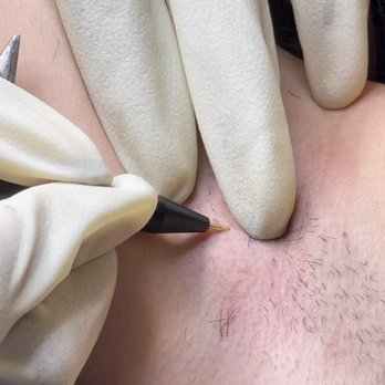Restored Electrology - Laser Hair Removal Near Me - Snellville, Georgia Restored Electrology - Laser Hair Removal Near Me - Snellville, Georgia