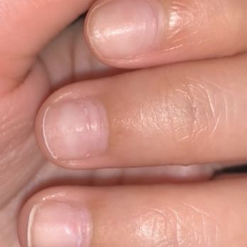 Honest Nails & Spa - And now worst of all: ring of fire on all my nails!! Horrible! Drilled too hard and at an angle. Never going back. - Nail Salons Near Me - Covington, Washington Honest Nails & Spa - And now worst of all: ring of fire on all my nails!! Horrible! Drilled too hard and at an angle. Never going back. - Nail Salons Near Me - Covington, Washington