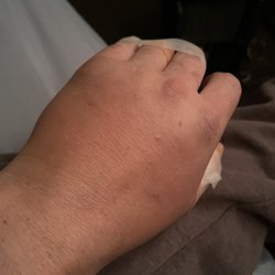 Sun N Sand Motel - Swollen hand 2 days later as I'm called a hypochondriac by manager & her family