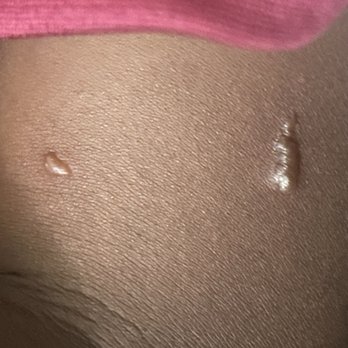 Alam Leah Berke, MD - CANTHARIDIN she added to the bump on the right side and it's not directly on the white bump - Dermatologists Near Me - Miami, Florida Alam Leah Berke, MD - CANTHARIDIN she added to the bump on the right side and it's not directly on the white bump - Dermatologists Near Me - Miami, Florida