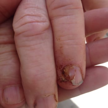 Silverado Calabasas Memory Care Community - Broken and dirty nails regularly unnoticed by staff at Calabasas - Assisted Living Facilities Near Me - Calabasas, California Silverado Calabasas Memory Care Community - Broken and dirty nails regularly unnoticed by staff at Calabasas - Assisted Living Facilities Near Me - Calabasas, California