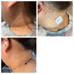Irene's Skintopia - Huge Skintag removal right after and 8weeks healed(left neck)
