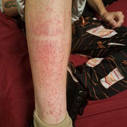 Presbyterian Kaseman Hospital - Rash climbing up my husband's right leg.