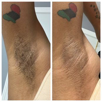 The Esty Zone - Sugared under arms - Waxing Near Me - Bridgeton, Missouri