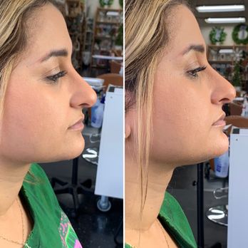 AboutFace Aesthetics - Chin filler for a slimmer, more balance face (by RN Nicole) - Aestheticians Near Me - Brea, California AboutFace Aesthetics - Chin filler for a slimmer, more balance face (by RN Nicole) - Aestheticians Near Me - Brea, California