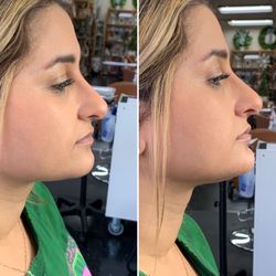 AboutFace Aesthetics - Chin filler for a slimmer, more balance face (by RN Nicole)