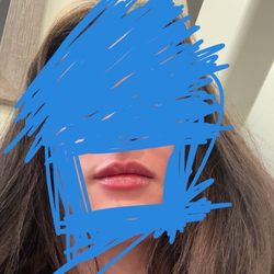 Maine Plastic Surgery - Lip filler by Christina