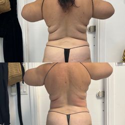 Beyoutifull Body - Sculptice full body treatment plus cavitation
