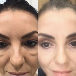 Bafitis Plastic Surgery: Dr. Harold Bafitis - Bleph before & after