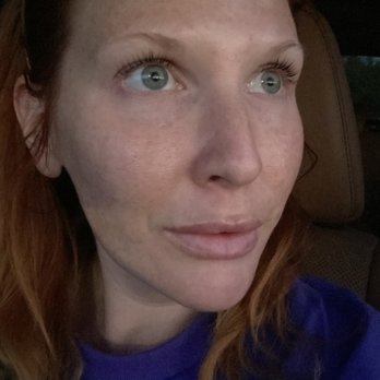 Sweet Skin - Right after - Skin Care Near Me - Phoenix, Arizona