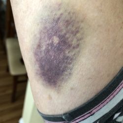 Labcorp - My arm two days after his very thoughtful stick I honestly believe he was getting back at me for trying to tell him something.