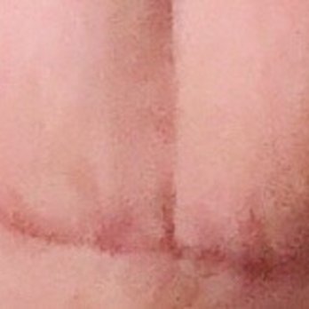 Pacific Heights Plastic Surgery - Tummy tuck scar :( - Cosmetic Surgeons Near Me - San Francisco, California