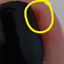 inflamed corner of finger nail cut too short.
