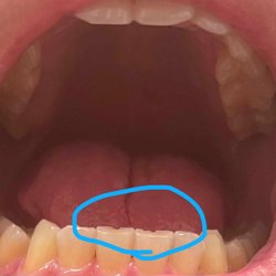Derek Lau, DMD - Chipped my 2 lower tooth with drill