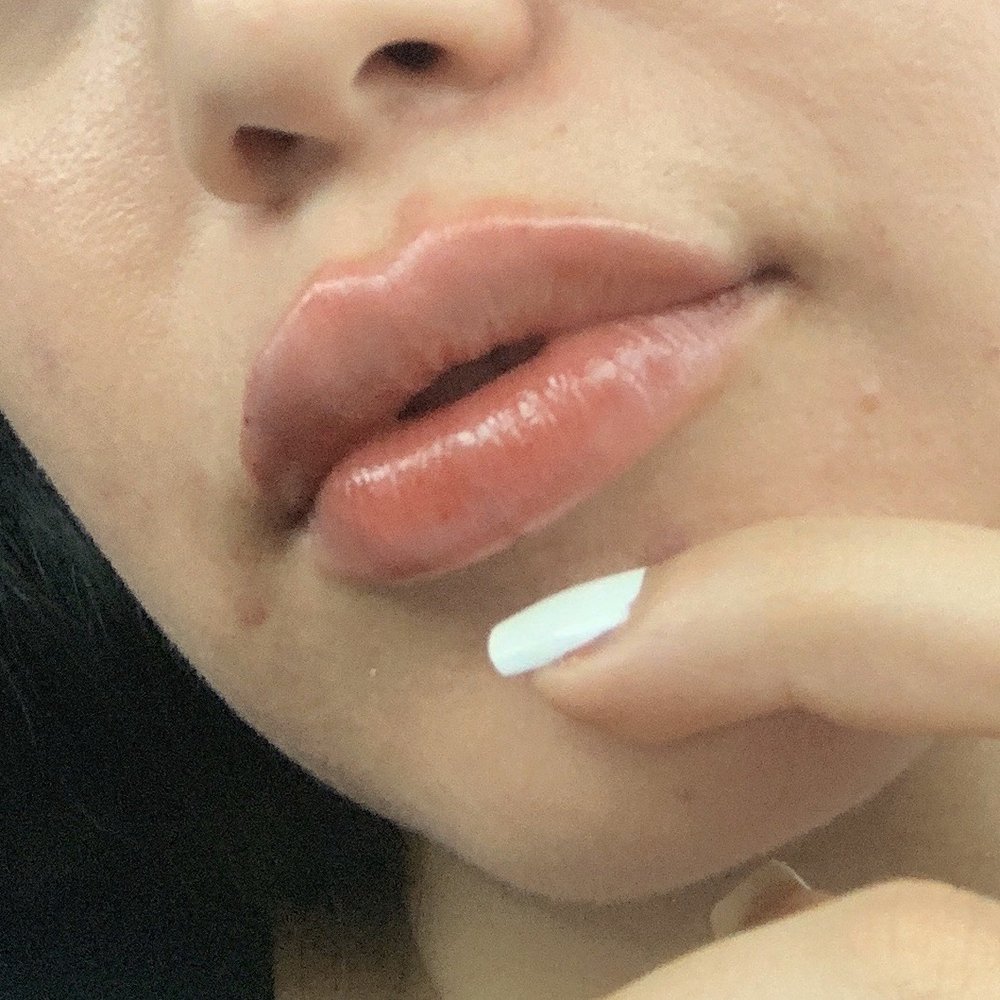 Impressions MedSpa - Juvederm .5 of syringe - Laser Hair Removal Near Me - Fairfax, Virginia Impressions MedSpa - Juvederm .5 of syringe - Laser Hair Removal Near Me - Fairfax, Virginia