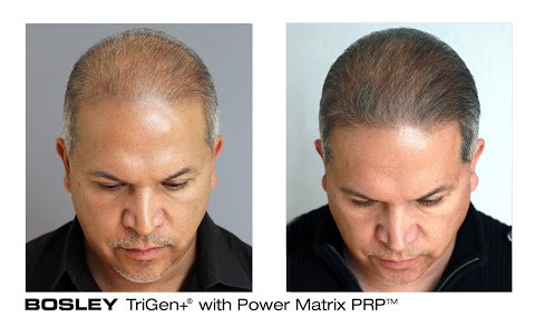 Bosley Hair Transplant Restoration 4001 S 700 E Salt Lake City Ut Hair Replacement Mapquest