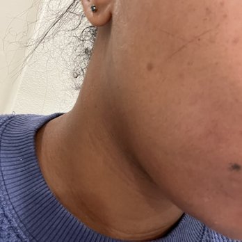 SEV Laser - Scratch was worse the next day - Laser Hair Removal Near Me - Dallas, Texas
