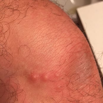 Paradise Resort - Bed bug bites from my stay at paradise.. There were many more, unfortunately we were ignorant to the harsh realities of bed bugs - Resorts Near Me - Myrtle Beach, South Carolina Paradise Resort - Bed bug bites from my stay at paradise.. There were many more, unfortunately we were ignorant to the harsh realities of bed bugs - Resorts Near Me - Myrtle Beach, South Carolina