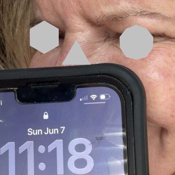 GLO30 - This is three weeks after treatment for glabella. - Skin Care Near Me - St. Louis, Missouri GLO30 - This is three weeks after treatment for glabella. - Skin Care Near Me - St. Louis, Missouri