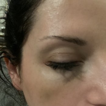 It's a Secret Med Spa - Worsening bruising and eyelid will barely open - Medical Spas Near Me - Frisco, Texas It's a Secret Med Spa - Worsening bruising and eyelid will barely open - Medical Spas Near Me - Frisco, Texas