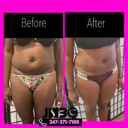Jadore Sarah Beauty Center - Noninvasive Abdominal fat reduction