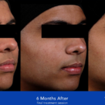 opulence glutathione before and after MEDICAL SPA - CLOSED - Updated August 2026 - 16 Photos - 1525 Franklin St, San Francisco, California - Medical Spas - Phone Number GHK-Cu: THE COPPER PEPTIDE Dexametasona Selection:60 Veg Capsules