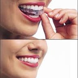 California Dental Group - Invisalign - Call Now to Receive $500 Off