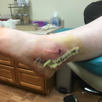 Select Foot and Ankle Specialists - Stitch removal!! - Podiatrists Near Me - Cypress, Texas Select Foot and Ankle Specialists - Stitch removal!! - Podiatrists Near Me - Cypress, Texas
