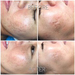 Atomic Beauty Company - Chemical Peel before/after