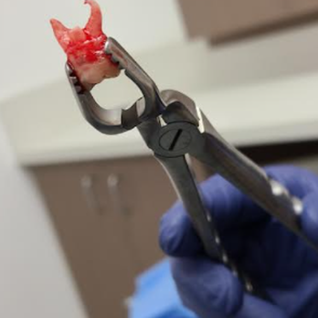 Formosa Dental Arts - The accursed wisdom tooth - Cosmetic Dentists Near Me - Irvine, California Formosa Dental Arts - The accursed wisdom tooth - Cosmetic Dentists Near Me - Irvine, California