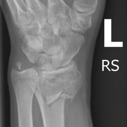 Hollywood Hands Rehabilitation - Don't fall down stairs!!!!
