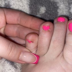 Anthony Vince Nail Spa - One peeling, the cut on the one next to it.
