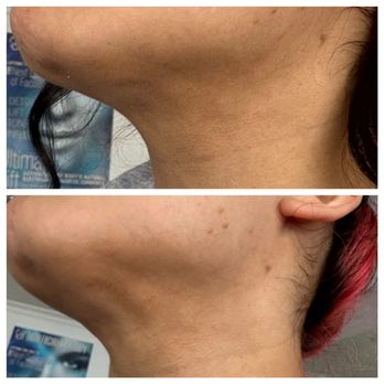 Bay Area Lymphatic & Post Lipo Massage - Chin lipo fibrosis treatment - Skin Care Near Me - Millbrae , California Bay Area Lymphatic & Post Lipo Massage - Chin lipo fibrosis treatment - Skin Care Near Me - Millbrae , California