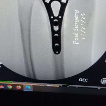 Franciscan Physician Network Orthopedic Specialists - What the first plate look like - Orthopedists Near Me - Indianapolis, Indiana Franciscan Physician Network Orthopedic Specialists - What the first plate look like - Orthopedists Near Me - Indianapolis, Indiana