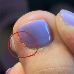 Big toe oozing/ irritated