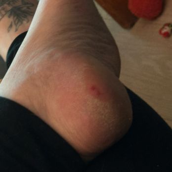 Star Nails - Thin skin on my heel where scraped too close with callous around - Nail Salons Near Me - Colorado Springs, Colorado Star Nails - Thin skin on my heel where scraped too close with callous around - Nail Salons Near Me - Colorado Springs, Colorado