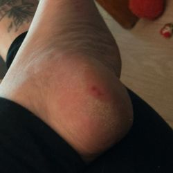 Star Nails - Thin skin on my heel where scraped too close with callous around