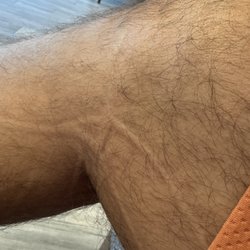 Restore Hyper Wellness - After the leg compression, this is my right knee and the neuropathy and plantar fasciitis was completely gone! No pain or numbness!
