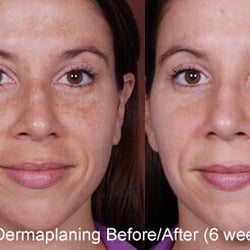 Perfection Beauty by Karen - Before and after dermaplaning!