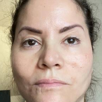 Injx By Nat - My face after procedure. - Medical Spas Near Me - Cranford, New Jersey
