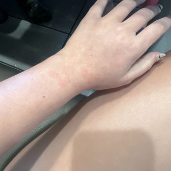 Boston / Cape Cod KOA - Bed bug bites - Campgrounds Near Me - Middleboro, Massachusetts
