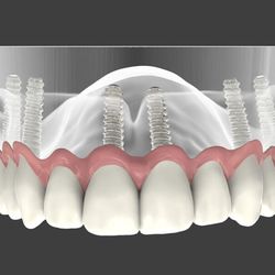 Progressive Periodontics and Implant Dentistry - Progressive Periodontics and Implant Dentistry, led by Dr. Marc Gordon, offers periodontal and dental implant care in Monmout...