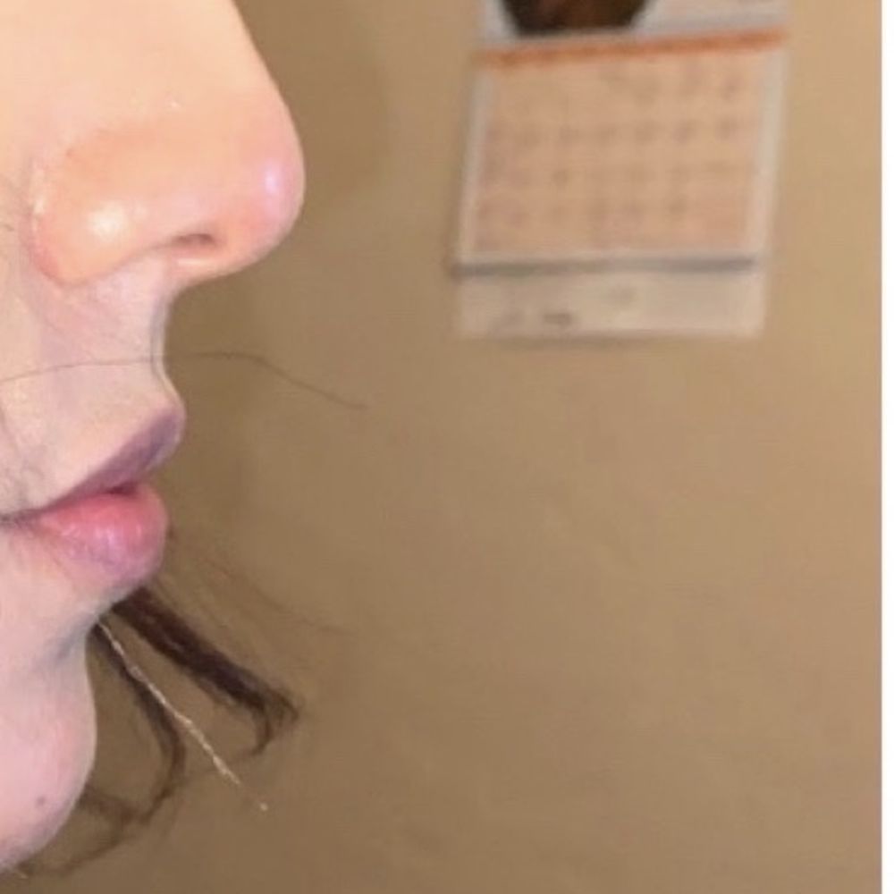 Lazer Lounge - My before : Bump/Nose - My lips - Laser Hair Removal Near Me - Studio City, California Lazer Lounge - My before : Bump/Nose - My lips - Laser Hair Removal Near Me - Studio City, California