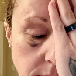 4Ever Young Med Spa & Wellness Center - Colorado Springs - April 20, 2026 -- Bruising progression